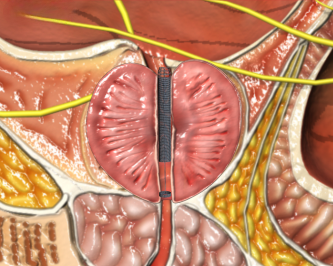 Stent placed in the prostatic urethra